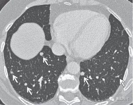 Pulmonary nodules can remove blood stasis as soon as possible in traditional Chinese medicine.