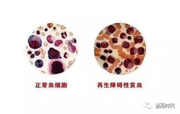 Aplastic anemia is the same as deficiency of fatigue and blood deficiency in traditional Chinese medicine