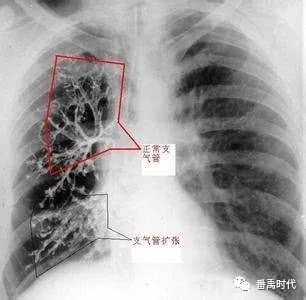 Treatment of lobar pulmonary isolation by TCM