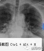 Causation of immunity and pulmonary consolidation