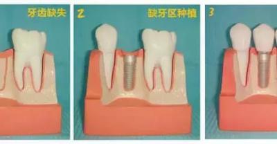 What are the advantages and disadvantages of immediate planting? What does immediate dental implant mean? is immediate implant bone graft immediate restoration?