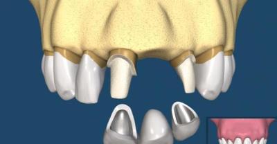 Advantages and disadvantages of dental implants (yarbeija science popularization)