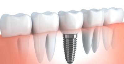 How much does dental implant cost?