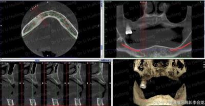 Which is better, porcelain teeth or implant teeth?