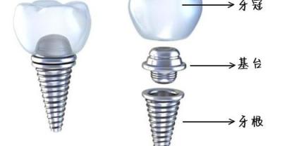 How to implant multiple missing teeth?