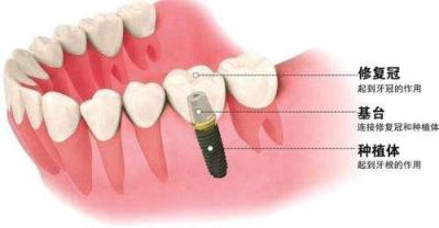 How much do you know about dental implants?