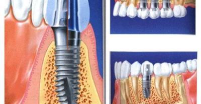 How long can dental implants last?