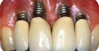 You must know the six benefits of dental implants