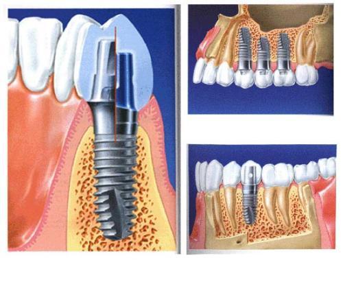 Is dental implant expensive? How much is it usually?