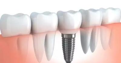 How long can I have implants after tooth extraction?