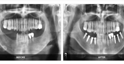 Can orthodontics be done after dental implants?