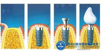 Implant tooth and porcelain tooth which ache more?