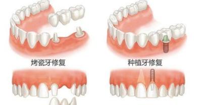 The most suitable implant for patients with diabetic osteoporosis