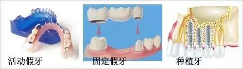 Which is better to implant teeth with VS insert?